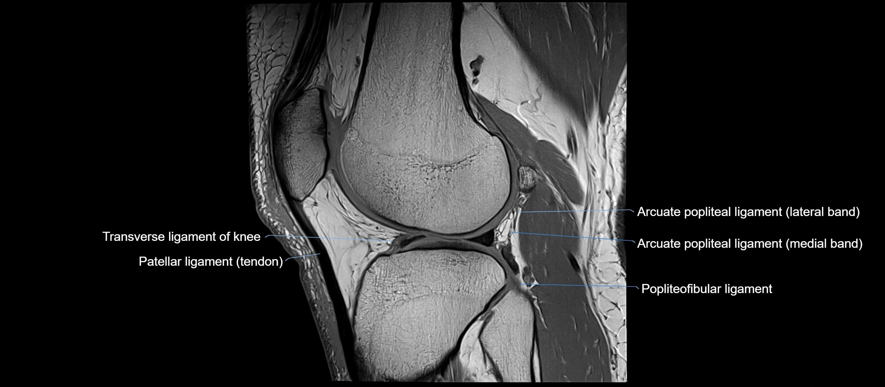 MRI sagittal  ligaments cross sectional anatomy 3T  radiology  image-img-00001-00033.webp